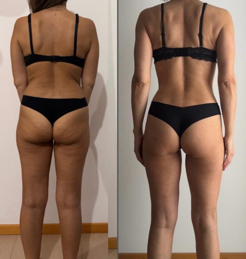 Antes e depois — 47 anos (costas)